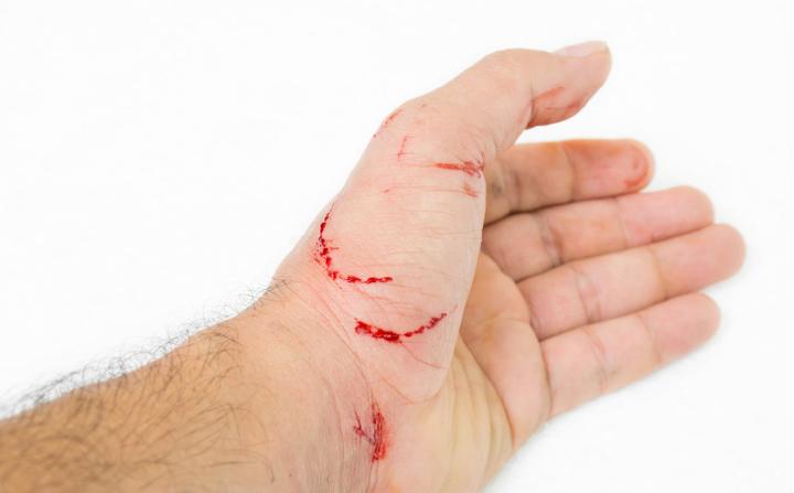 Zadrapanie przez kota