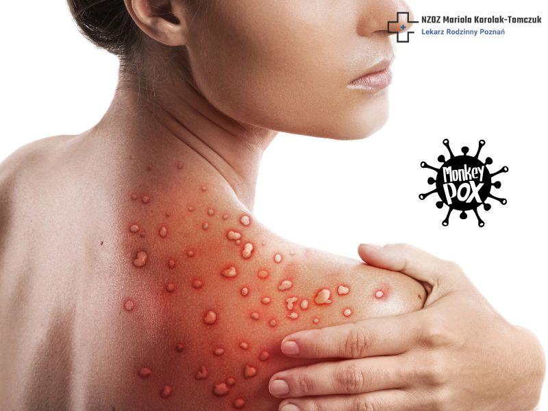 Malpia ospa profilaktyka