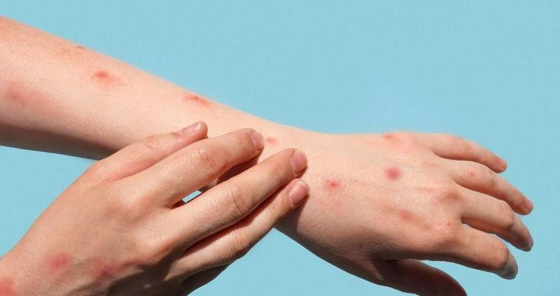 Malpia ospa zdrowie publiczne