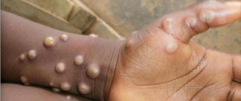 Malpia ospa – co warto wiedzieć o tej egzotycznej chorobie?